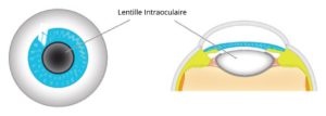 Lentille intraoculaire phaque