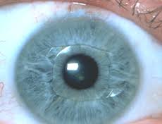 implant de lentilles intraoculaires phaques ou ICL - oeil