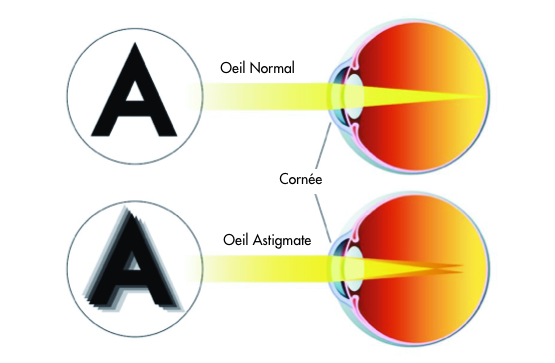 correction de l'astigmatisme - centre vision laser rabat