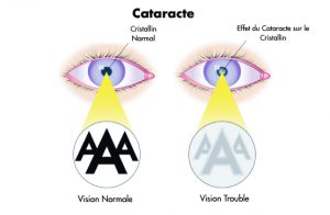 soigner la cataracte - centre vision laser maroc