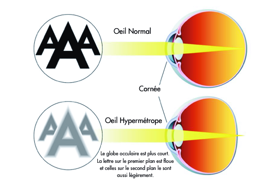 soigner l'hypermétropie au maroc
