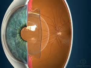 implant de lentilles intraoculaires phaques ou ICL