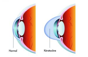 opération et traitements du kératocône rabat maroc