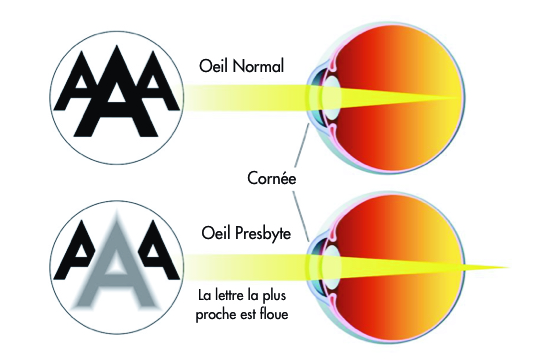 traitements de la presbytie - centre vision laser maroc