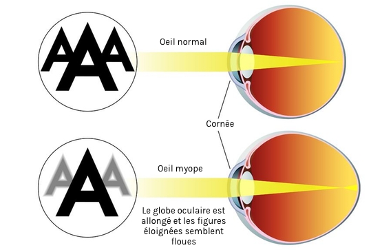 Traitements de la myopie - centre vision laser rabat