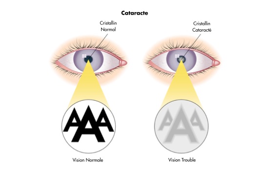 soin et opération de la cataracte - centre vision laser maroc