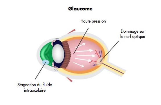 traitement du glaucome - centre vision laser rabat maroc