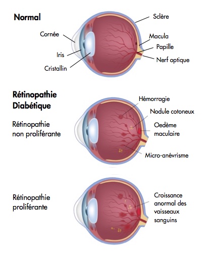 traiter la rétinopathie diabétique - proliférante et non proliférante