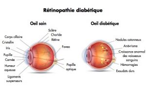 traiter la rétinopathie diabétique