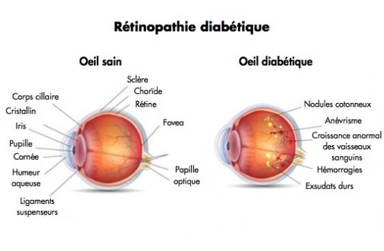 traiter la rétinopathie diabétique