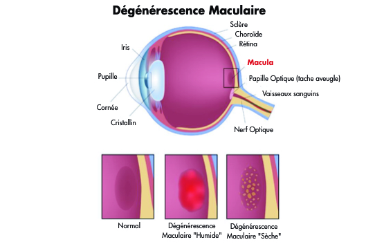 traiter la dégénérescence maculaire DMLA