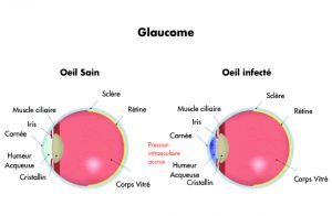 traitement glaucome - centre vision laser rabat maroc