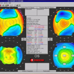 topographie Orbscan - Centre Vision Laser Maroc